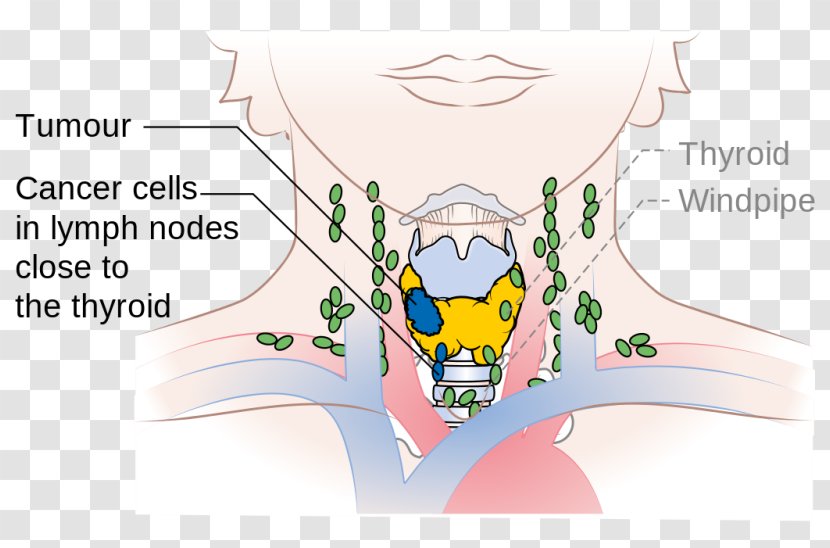 Cervical Lymph Nodes Thyroid Cancer Paratracheal - Silhouette - Heart Disease Transparent PNG