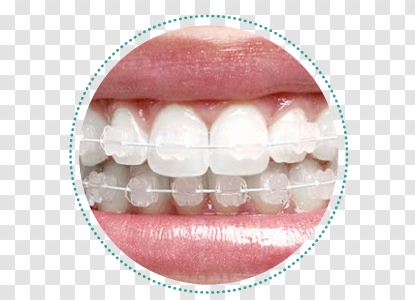 Dental Braces Orthodontics Dentistry Tratamento - Mouth - Bracket Transparent PNG
