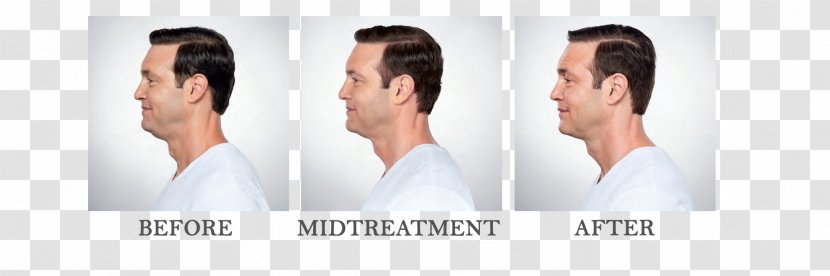 INTERLOCKS Salon + Spa Adipose Tissue Deoxycholic Acid Chin Surgery - Face Transparent PNG