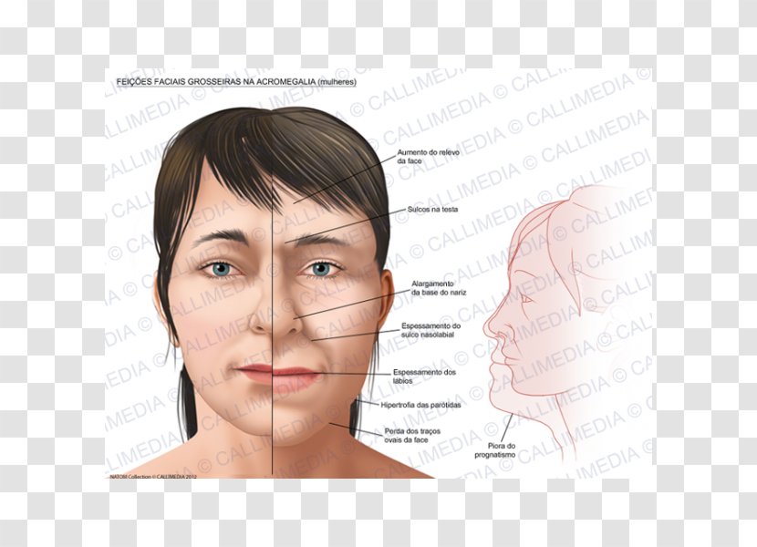 Acromegaly Face Symptom Hypertrophy Growth Hormone - Flower Transparent PNG