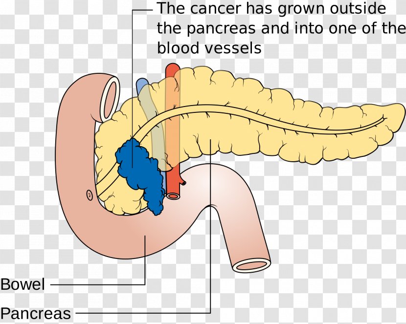 Pancreatic Cancer Pancreas Disease Death - Cartoon - Tree Transparent PNG