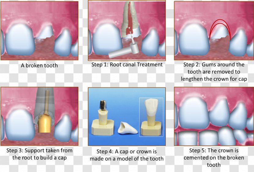 Crown Root Canal Cracked Tooth Syndrome Human Transparent PNG