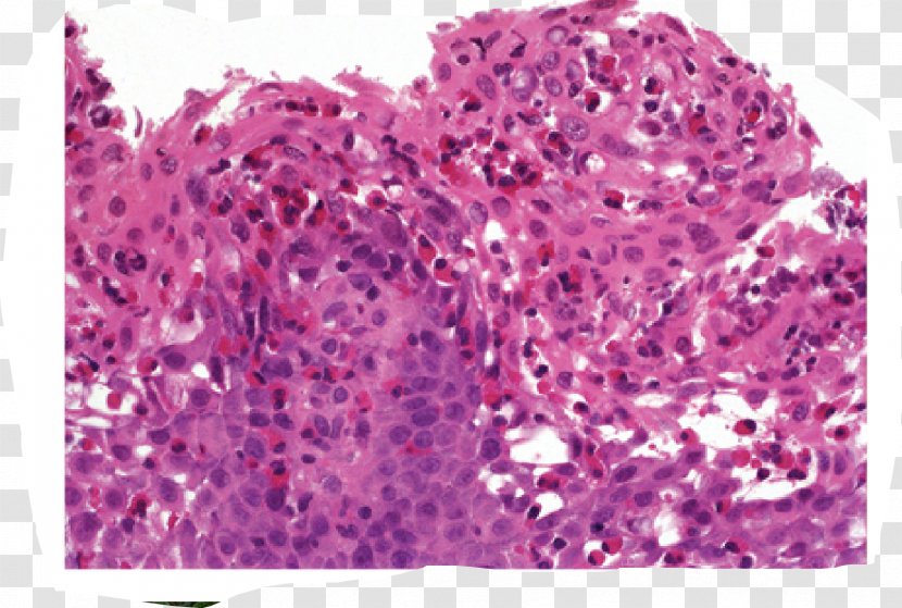 Eosinophilic Esophagitis Esophagus Dysphagia - Violet - Neutrophil Transparent PNG