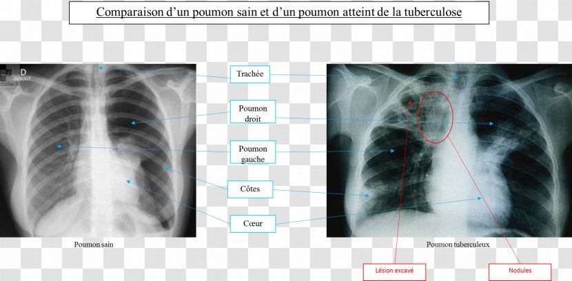 Tuberculosis Radiology Lung Medicine Infectious Disease - Medical Sign - Fumer Transparent PNG