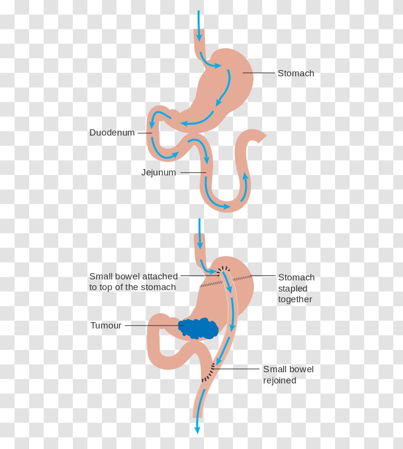 Gastric Bypass Surgery Sleeve Gastrectomy Obesity - Silhouette - Watercolor Transparent PNG