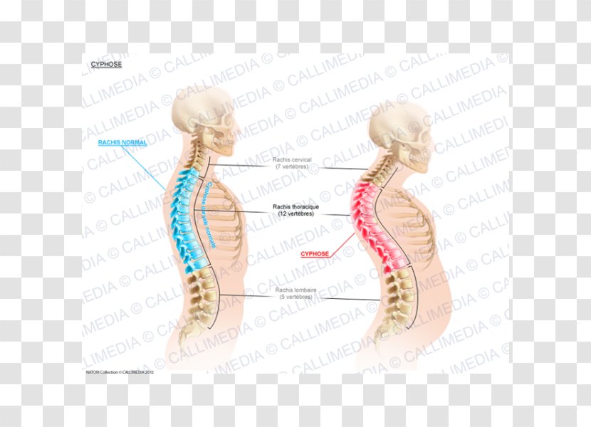 Kyphosis Lordosis Cervical Vertebrae Vertebral Column Scoliosis - Flower - Digestif Transparent PNG