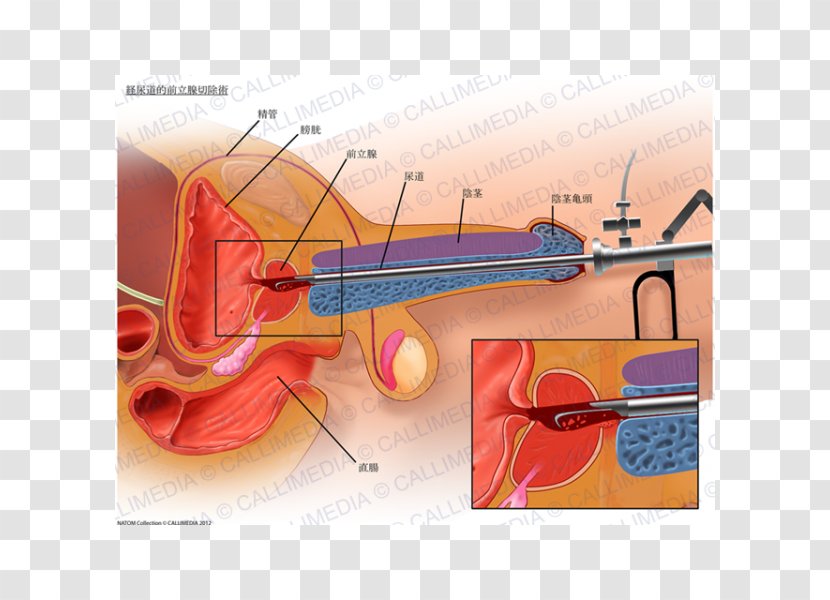 Transurethral Resection Of The Prostate Benign Prostatic Hyperplasia Cancer Surgery - Watercolor - Gland Transparent PNG