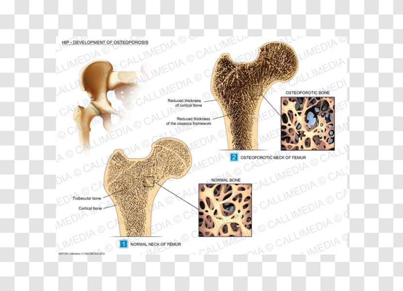 Hip Osteoporosis Rheumatology Osteoarthritis Illustration Anatomique - Bone Fracture Transparent PNG