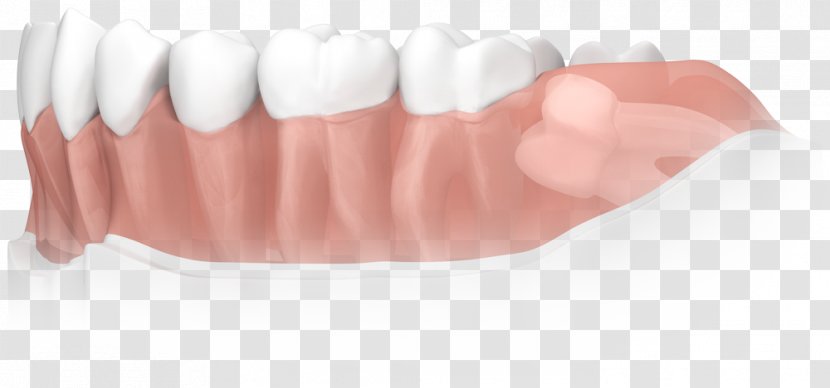 Tooth Apicoectomy Dental Surgery Dentistry - Turkish Lira - Mouth Transparent PNG