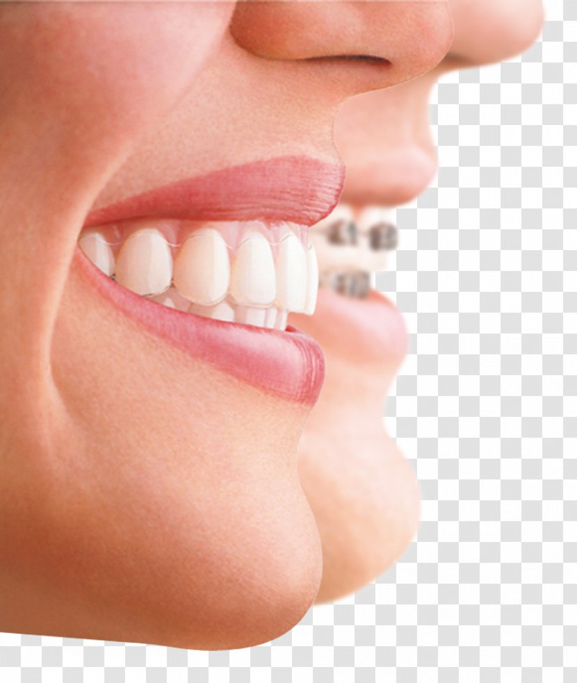 Clear Aligners Dental Braces Orthodontics Veneer Dentistry - Tooth Whitening - Crown Transparent PNG