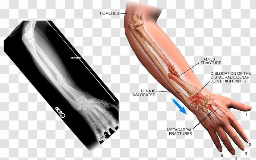 Thumb Arm Sprain X-ray - Finger - Sprained Transparent PNG