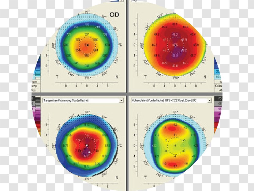 Cataract Corneal Topography Eye Examination - Surgery Transparent PNG