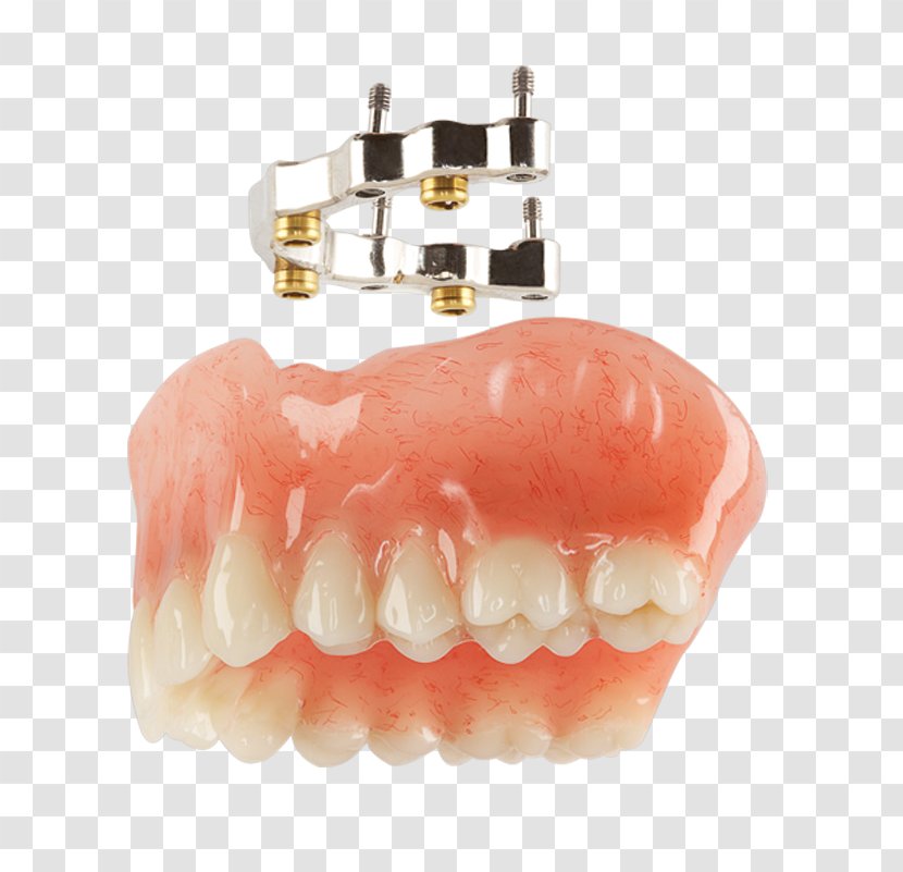 Overdentures Tooth Dental Implant Bars - Dentist - Overdenture Transparent PNG