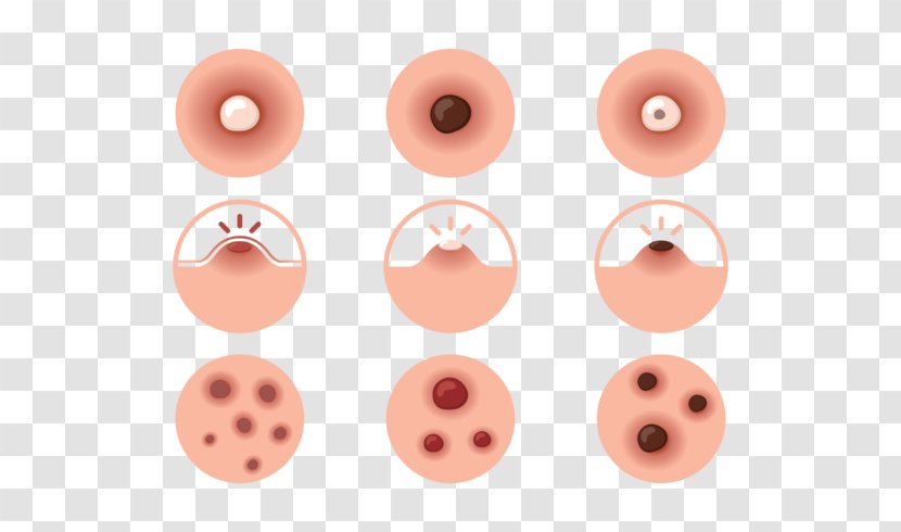 Propionibacterium Acnes Anxiety Nose Cheek - Button - Pimple Transparent PNG