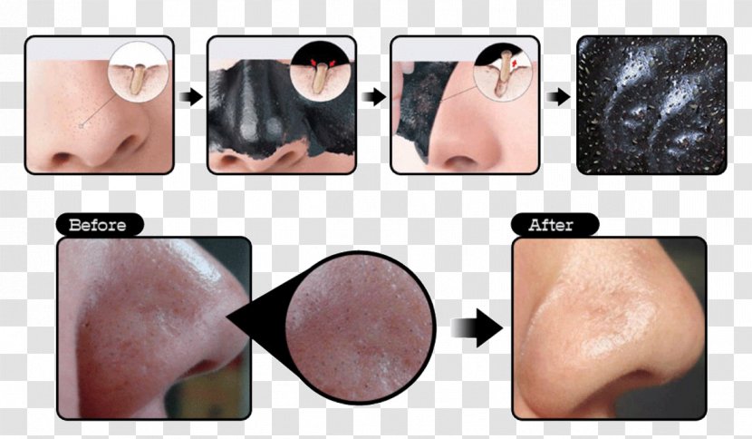 Comedo Mask Facial Cleanser Acne - Cartoon Transparent PNG