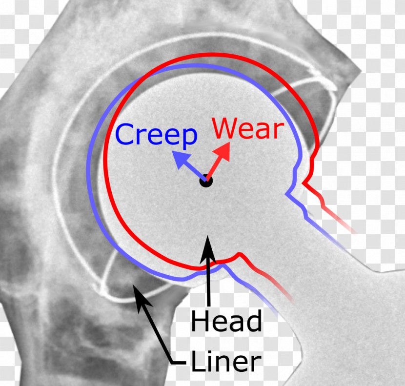 Hip Replacement Arthroplasty Surgery Prosthesis - Heart - Ear Transparent PNG