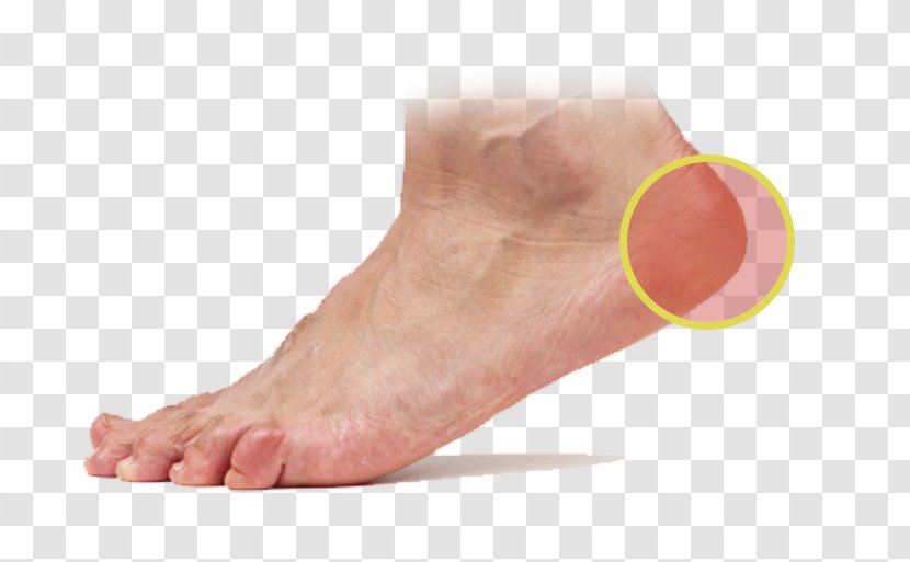 Foot Podiatry Skin Plantar Fasciitis Sole - Silhouette - Injury Trouble Transparent PNG