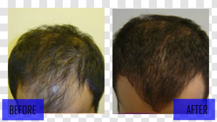 Hair Transplantation Loss Wig Black - Dutasteride Transparent PNG