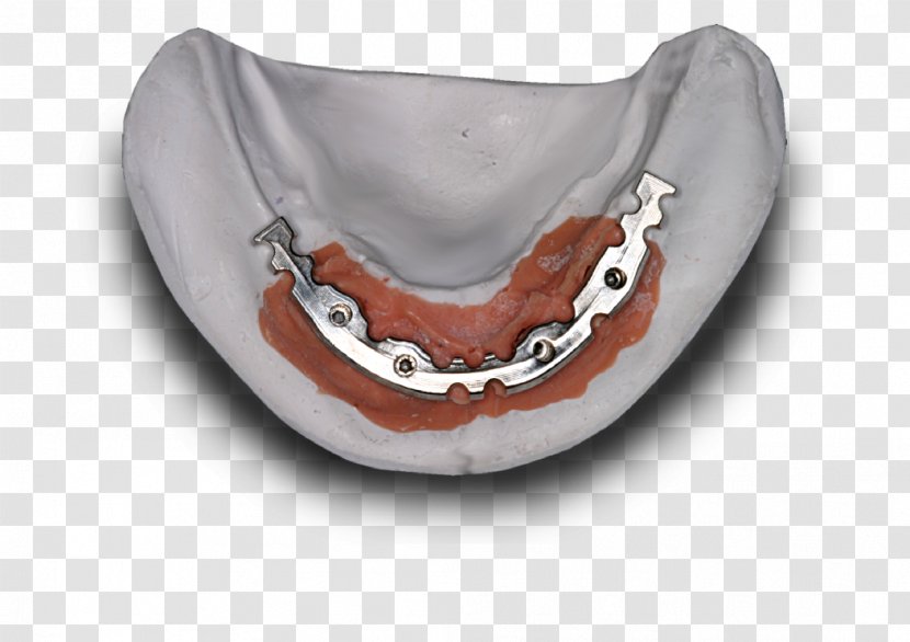 Jaw Dental Implant Laboratory Dentistry Dentures - Bremadent Transparent PNG