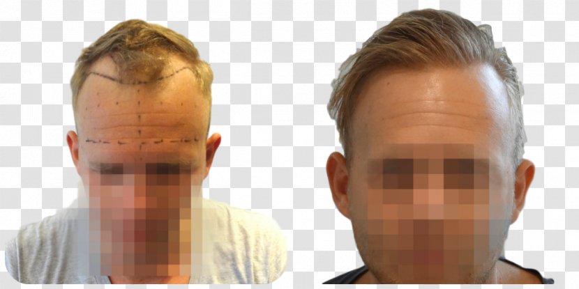 Hair Transplantation Follicular Unit Extraction Eyebrow Hairstyle - Neck - Head Transparent PNG