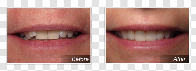 Dr. Michael E. Huguet, DDS Tooth Cosmetic Dentistry Clear Aligners - Lip - Gastroesophageal Reflux Disease Transparent PNG