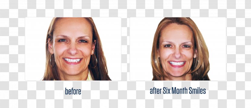 Cosmetic Dentistry Dental Braces Overbite - Long Hair - Before And After Transparent PNG