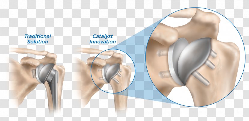 Shoulder Replacement Implant Surgery Humerus - Cartoon - Strengthen Protection Transparent PNG