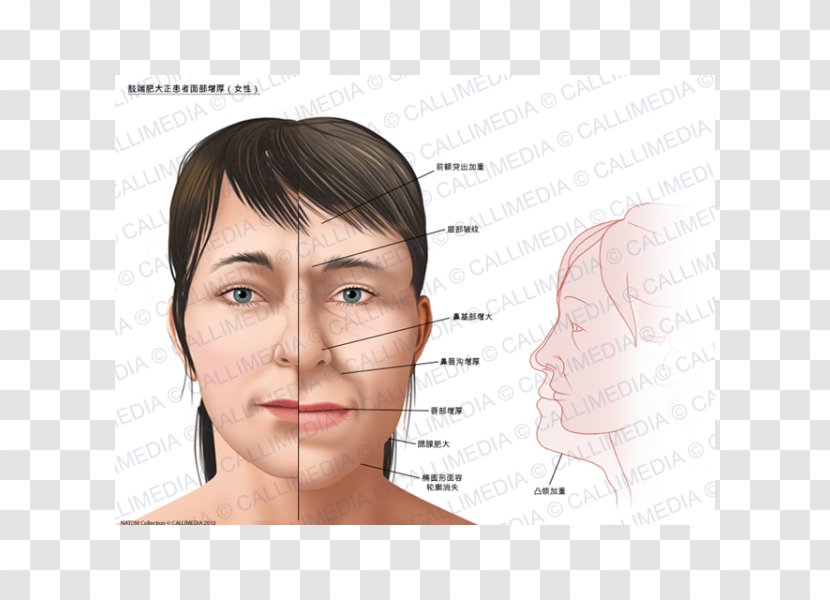 Acromegaly Gigantism Face Symptom Growth Hormone - Heart Transparent PNG
