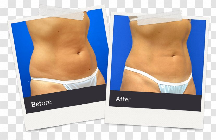 East Brunswick Township Body Contouring Surgery After Weight Loss Liposuction - Watercolor - Princeton Plastic Surgeons Transparent PNG