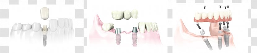 Product Design Abutment Cutlery - Dental Implant Transparent PNG
