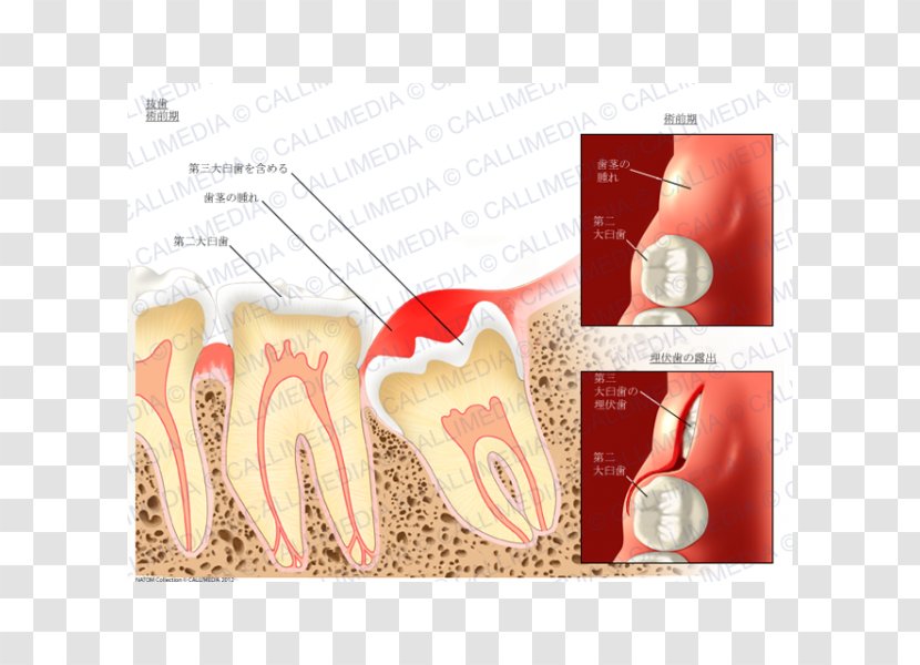 Dental Extraction Tooth Dentistry Molar - Incisor - Canine Transparent PNG