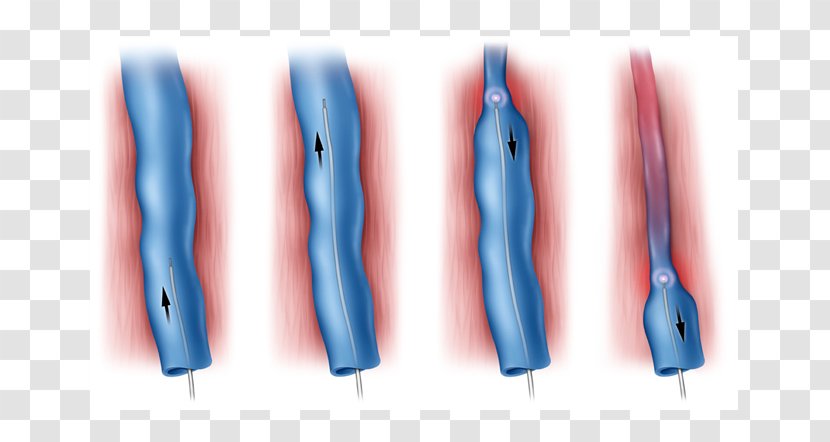 Endovenous Laser Treatment Varicose Veins Surgery - Shoulder Transparent PNG