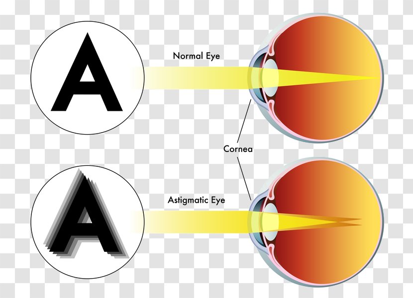 LASIK Astigmatism Refractive Surgery Eye - Intraocular Lens - Myopia Transparent PNG