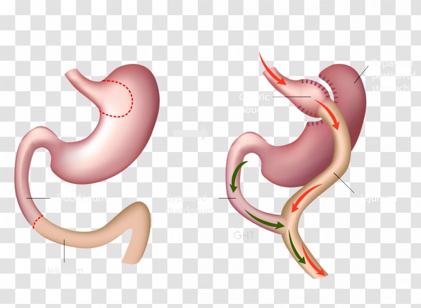 Gastric Bypass Surgery Bariatric Roux-en-Y Anastomosis Sleeve Gastrectomy - Watercolor - Health Transparent PNG