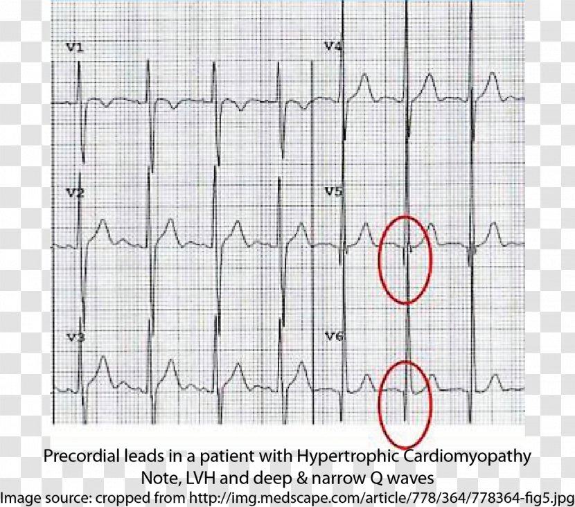 Hypertrophic Cardiomyopathy Electrocardiography Syncope Cardiac Arrest - Paper Transparent PNG