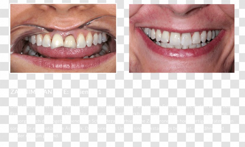 Dentures Close-up Human Tooth - Lip - Tongue Transparent PNG