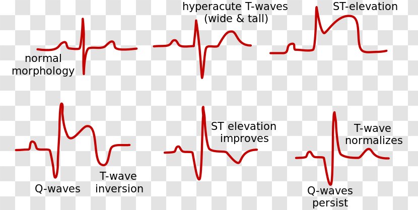 ST Elevation Acute Myocardial Infarction Segment Electrocardiography - St Transparent PNG