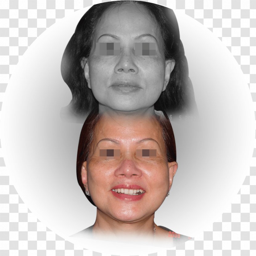 Cheek Eye Light Rhytidectomy Forehead - Ageing Transparent PNG