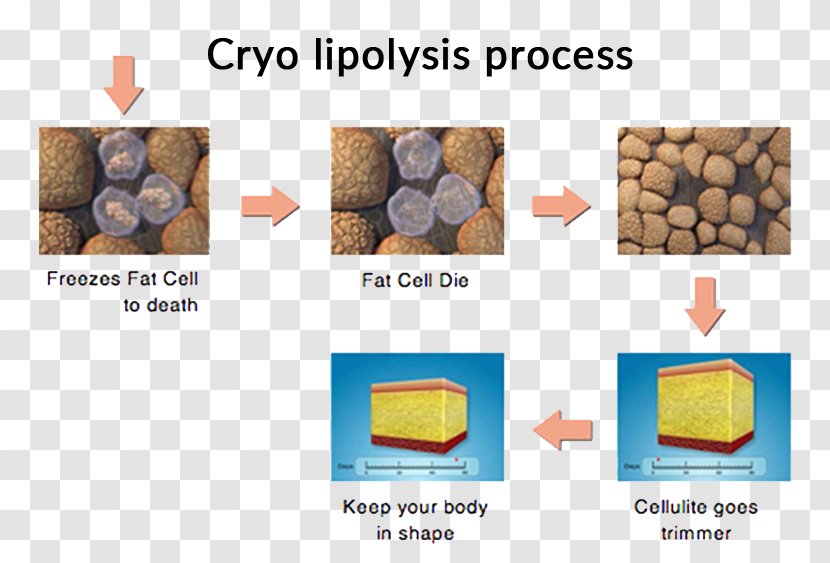 Cryolipolysis Liposuction Adipose Tissue Cellulite - Adipocyte Transparent PNG