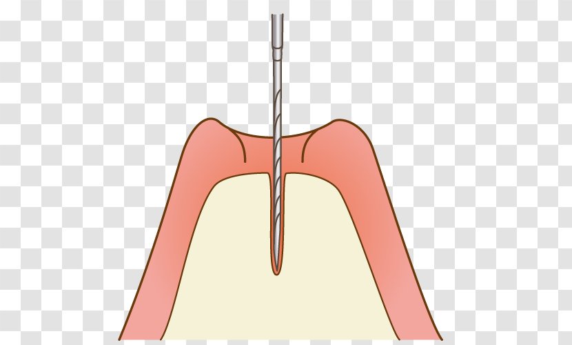Sinus Lift Maxillary Dental Implant Paranasal Sinuses Bone - Cartoon - Dentistry Transparent PNG