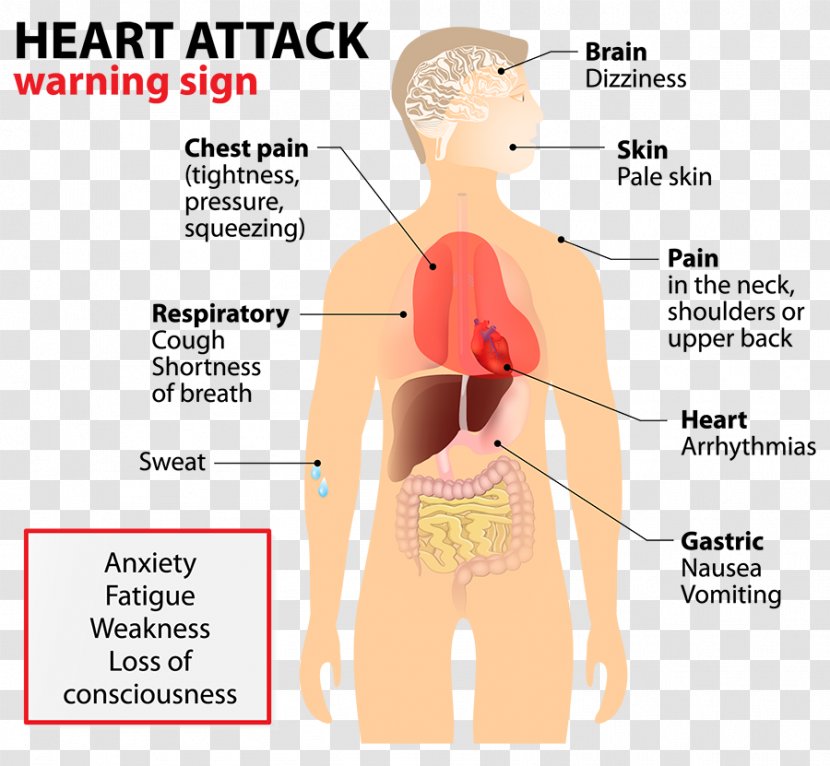 Acute Myocardial Infarction Heart Cardiovascular Disease Health Transparent PNG