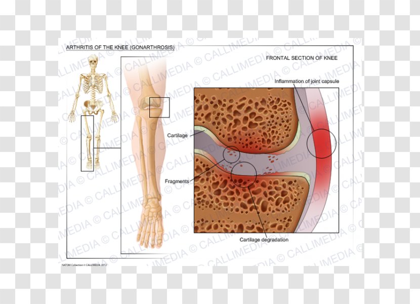 Shoulder Knee Osteoarthritis Arthritis - Cartoon - Arm Transparent PNG