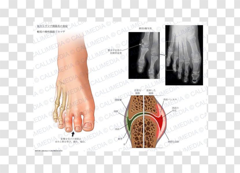 Nail Arthritic Pain Rheumatoid Arthritis Foot Joint - Heart Transparent PNG