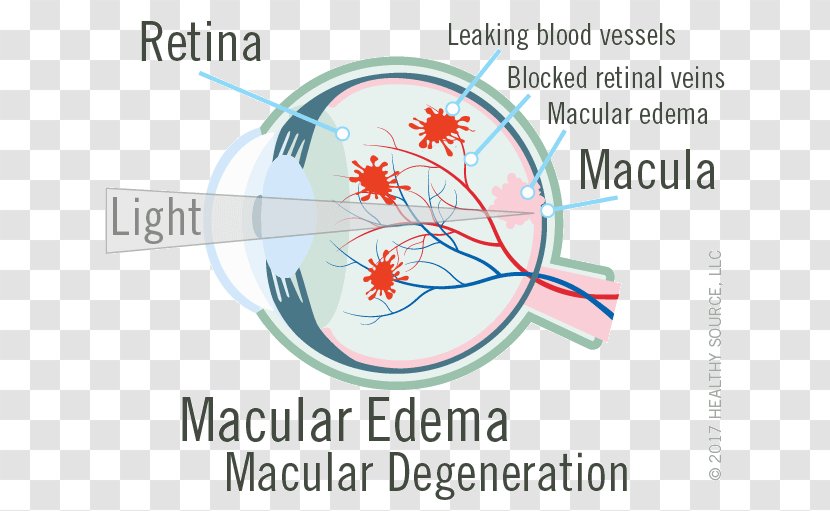 Macula Of Retina Macular Edema Central Retinal Vein Occlusion - Heart - Eye Transparent PNG