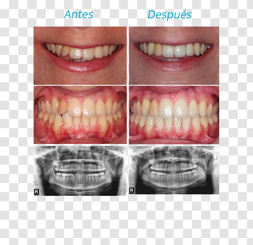 Tooth Orthodontics Malocclusion Dr. Castaños Ortodoncia Incisor - Smile - Justify Transparent PNG