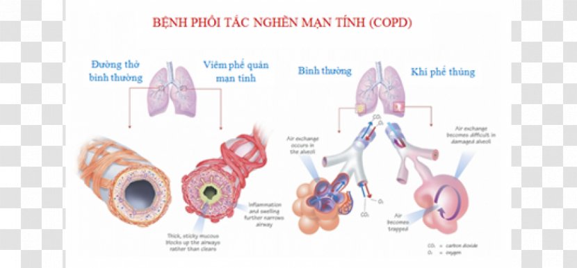 Chronic Obstructive Pulmonary Disease Bronchitis Lung - Watercolor Transparent PNG