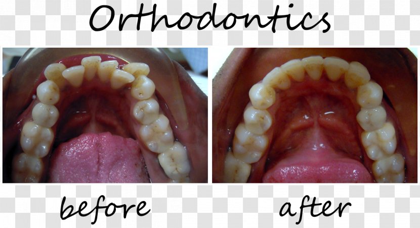 Orthodontics Dentistry Veneer Smiles Of Cary The Lumineers - Tooth Transparent PNG