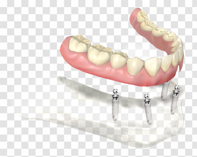 Dentures Dental Implant Dentistry Prosthesis Abutment - Tooth - Removable Partial Denture Transparent PNG
