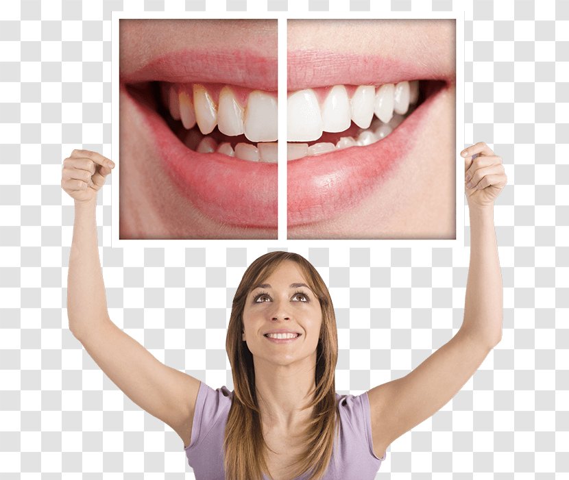 Tooth Whitening Dentistry Human - Lip - Surgery Transparent PNG