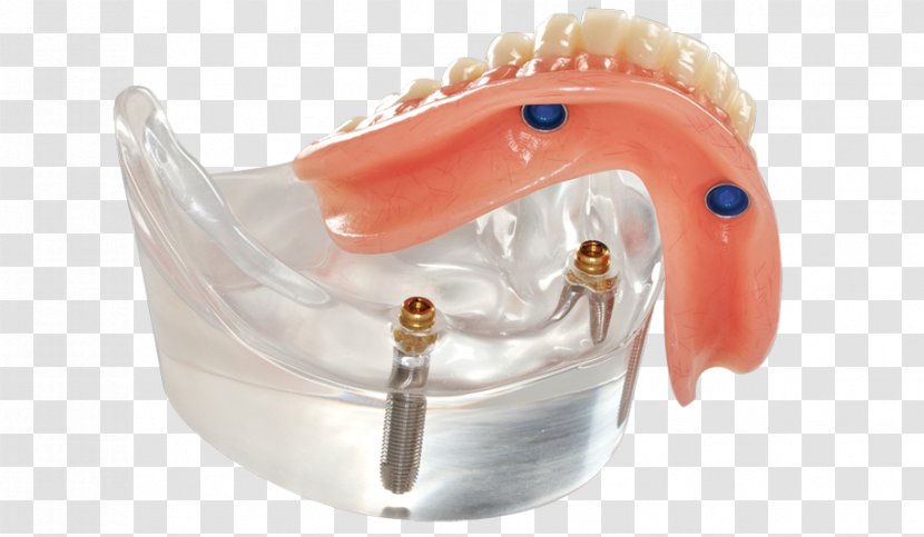 Dentures Dental Implant Dentistry Removable Partial Denture All-on-4 - Bridge Transparent PNG